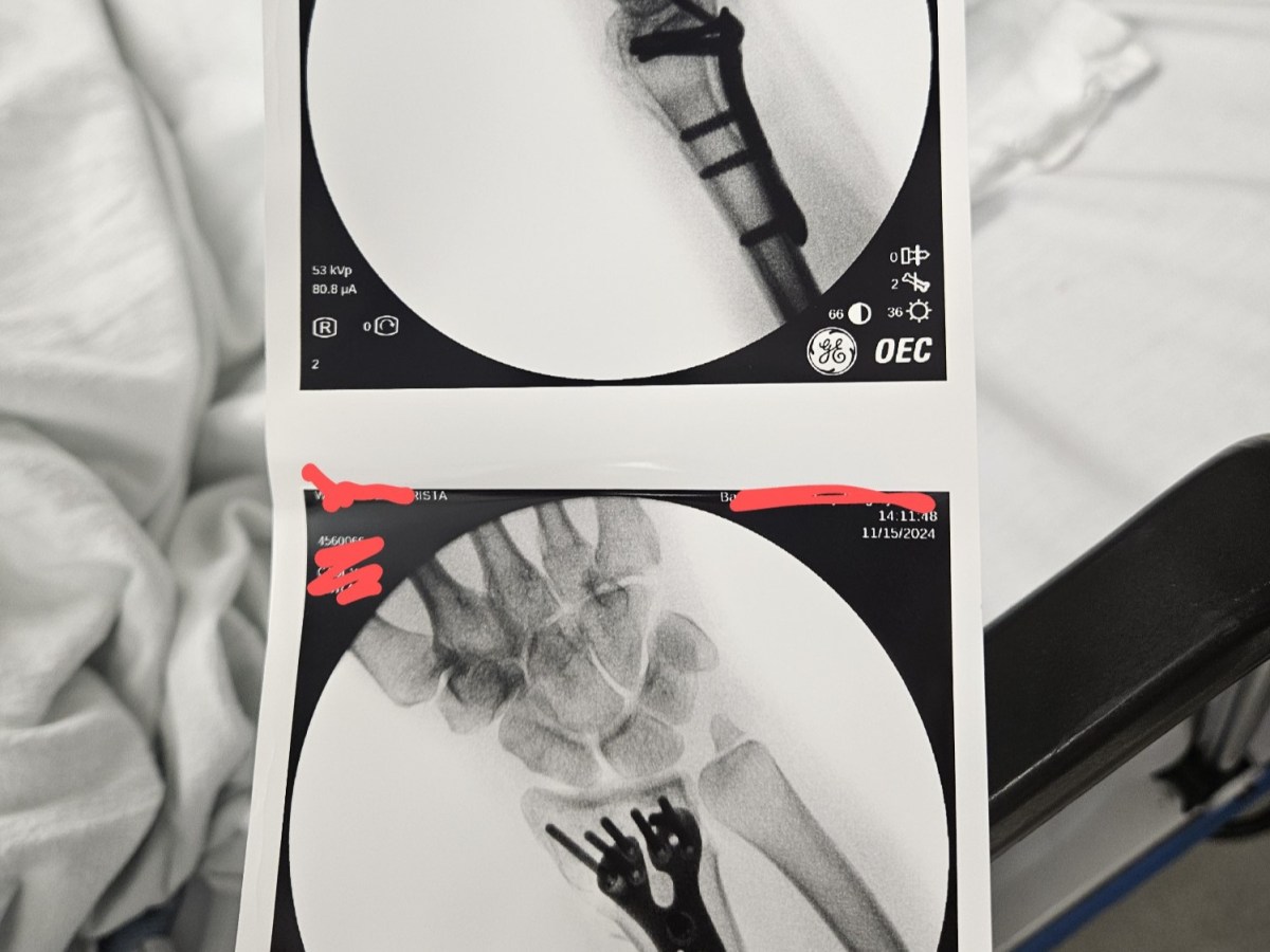 fractures (with apologies to william carlos&nbsp;williams)